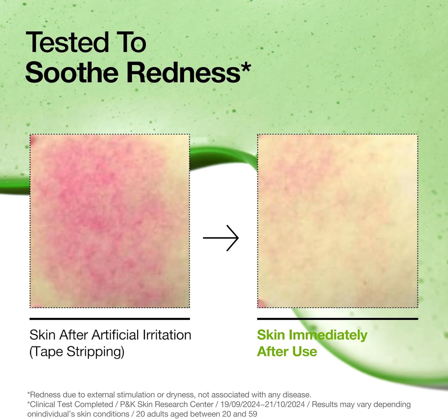 ANUA Azelaic Acid 10 Hyaluron Redness Soothing Serum